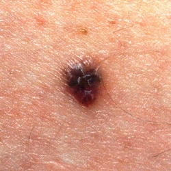 Los tratamientos combinados revolucionarán la atención a los pacientes con melanoma