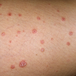 Adolescente desarrolla tratamiento natural contra la psoriasis