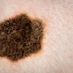 Una combinación de dos fármacos aumenta la eficacia del tratamiento del melanoma