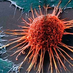 Científicos del IBEC describen cómo las células cancerígenas del tumor mamario se adhieren al tejido endurecido.