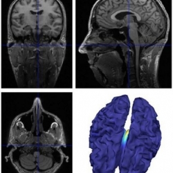 Identifican un mecanismo que causa la epilepsia y la resistencia a la medicación