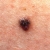 Los tratamientos combinados revolucionarán la atención a los pacientes con melanoma