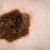 A medida que ha cambiado la cultura, también ha cambiado el riesgo de melanoma