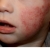 El seguimiento dermatológico "online" en la dermatitis atópica logra resultados equivalentes