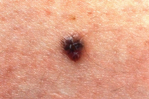 Los tratamientos combinados revolucionarán la atención a los pacientes con melanoma