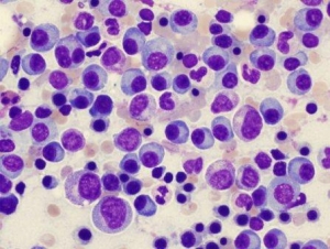 Europa; Se aprueba lenalidomida para pacientes con mieloma múltiple de nuevo diagnóstico