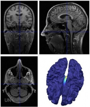 Identifican un mecanismo que causa la epilepsia y la resistencia a la medicación